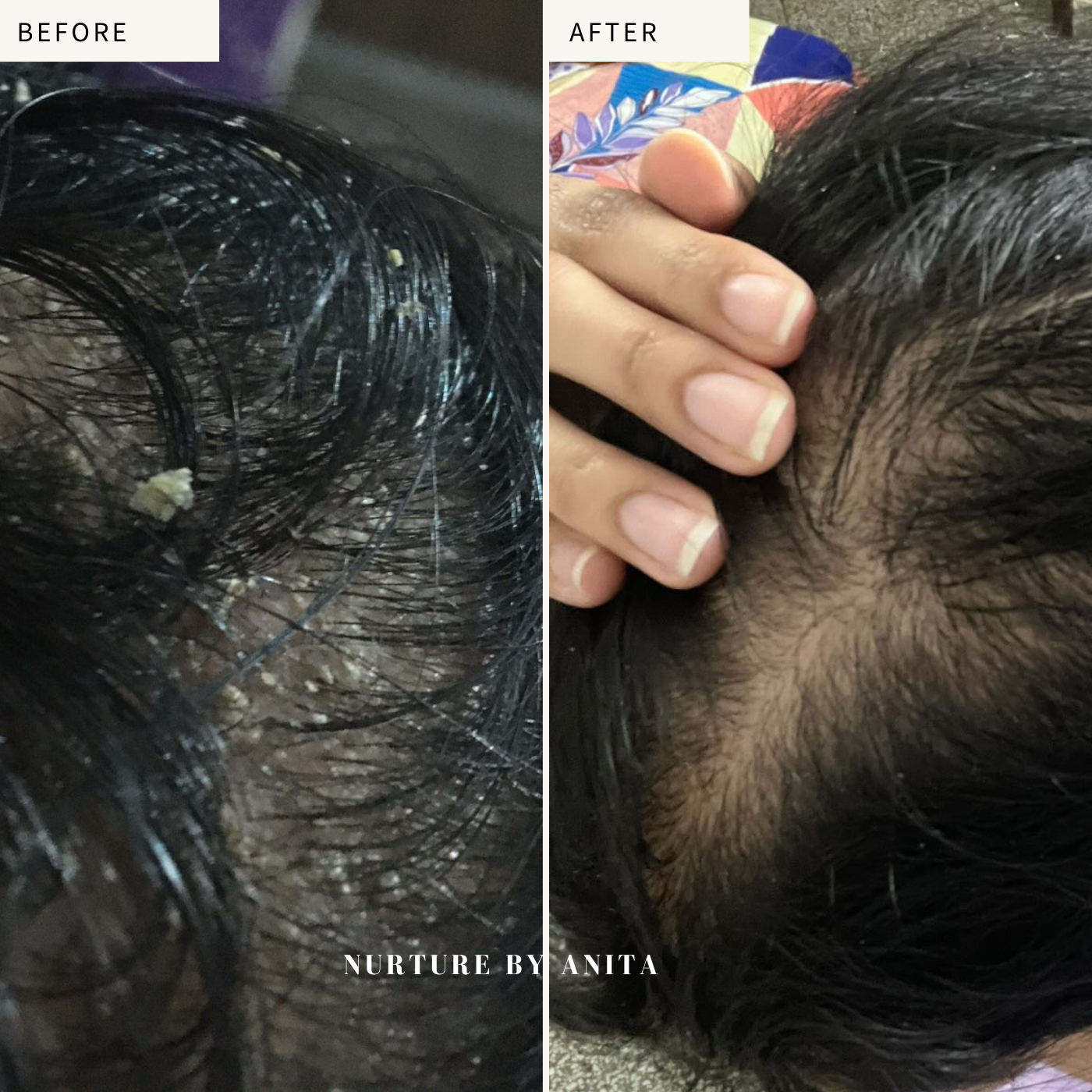 Customer results facing seborrheic dermatitis and scalp infection