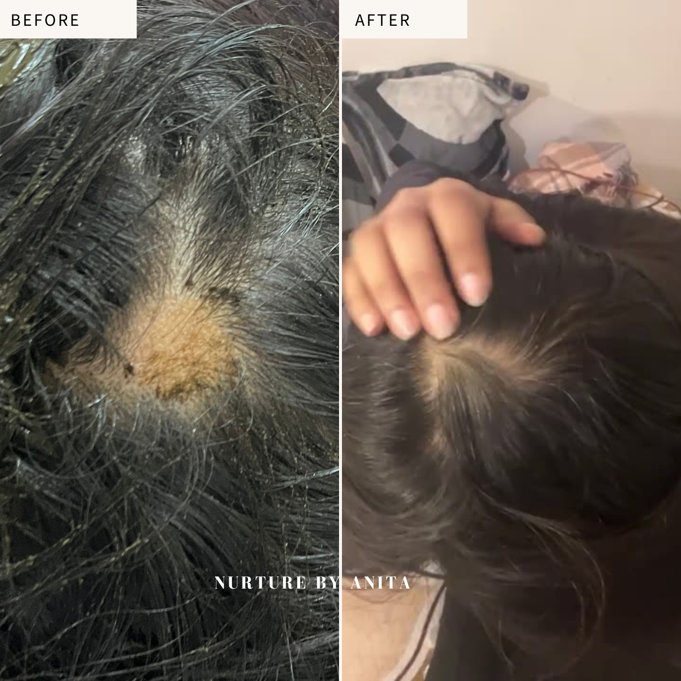 Customer results facing scalp fungal infection and bald patch