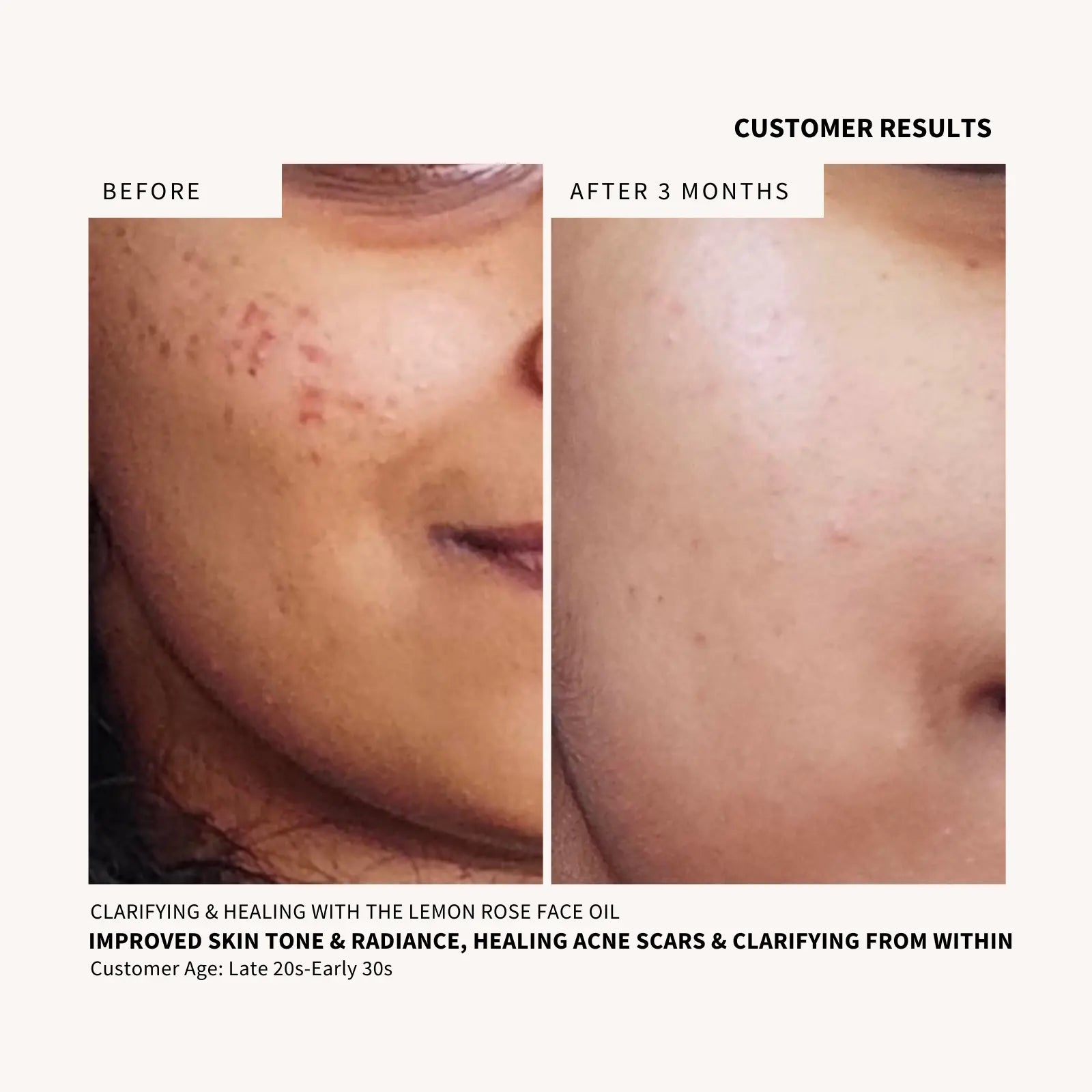 Lemon Rose Face Oil - NURTURE BY ANITA - customer results with acne healing