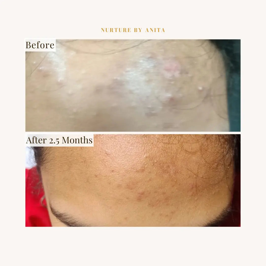 Lemon Rose Face Oil - NURTURE BY ANITA - customer results with acne healing