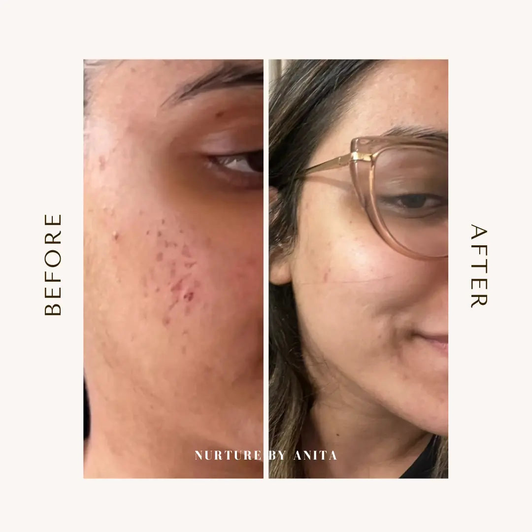 Lemon Rose Face Oil - NURTURE BY ANITA - customer results - acne healing