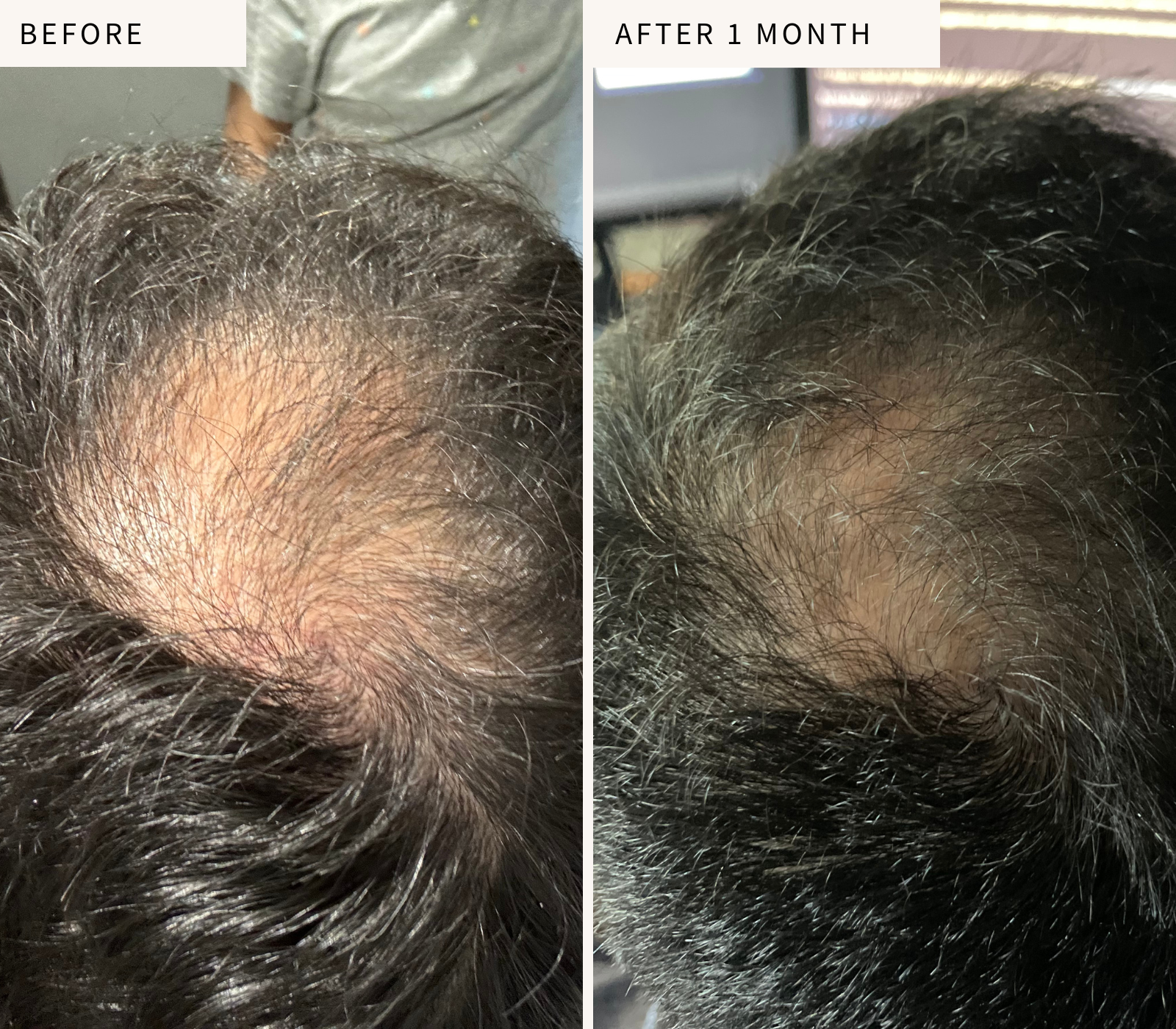 male pattern balding results with the rosemary bhringraj and mustard hair oil